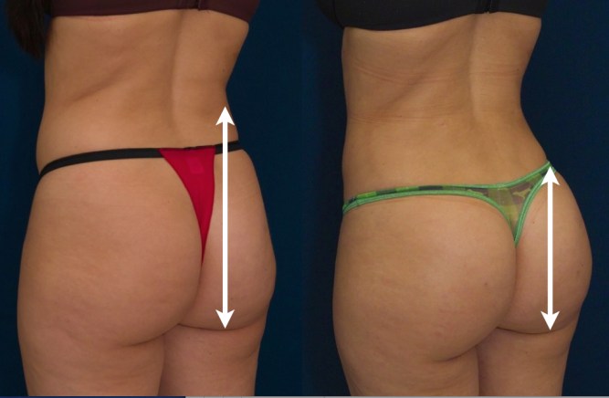 brazilian-butt-lift-side-photo-baltimore